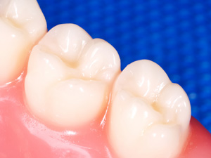 矯正治療中の虫歯対策